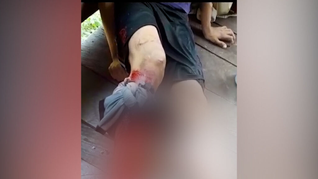 Homem fica com perna dilacerada ao ser atacado por jacaré no Amazonas; veja vídeo